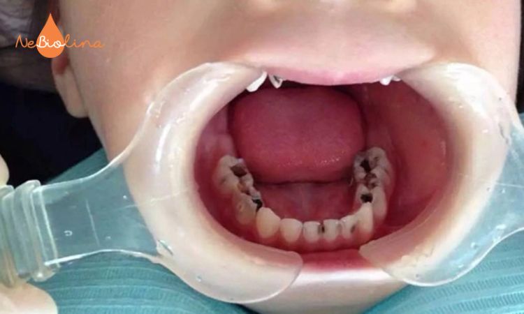 Sâu răng sữa có thể ảnh hưởng răng vĩnh viễn