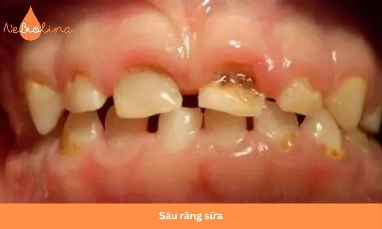 Sâu răng sữa có thể ảnh hưởng đến mầm răng vĩnh viễn.