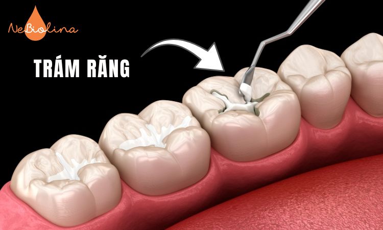 Trám răng phù hợp cho sâu răng nhẹ.