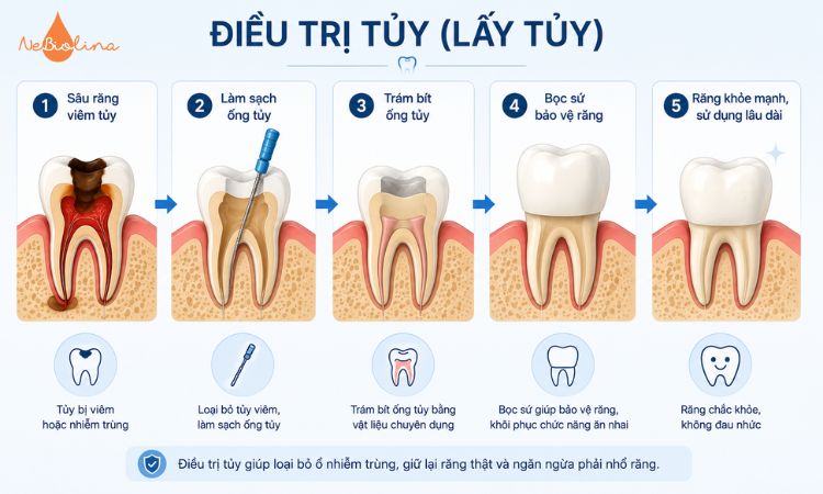 Quy trình điều trị tủy và trám bít ống tủy 