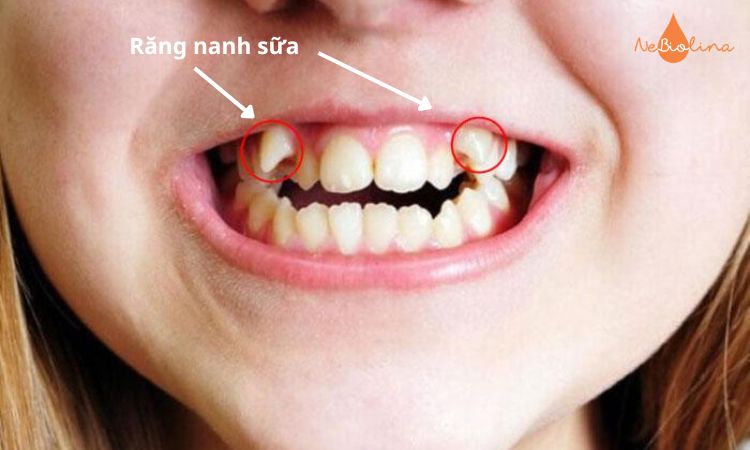 Răng nanh sữa là chiếc răng dễ nhận ra nhất nhờ hình dạng đặc trưng. 