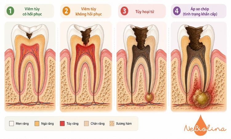 Sâu răng nặng được chia thành 4 mức độ.