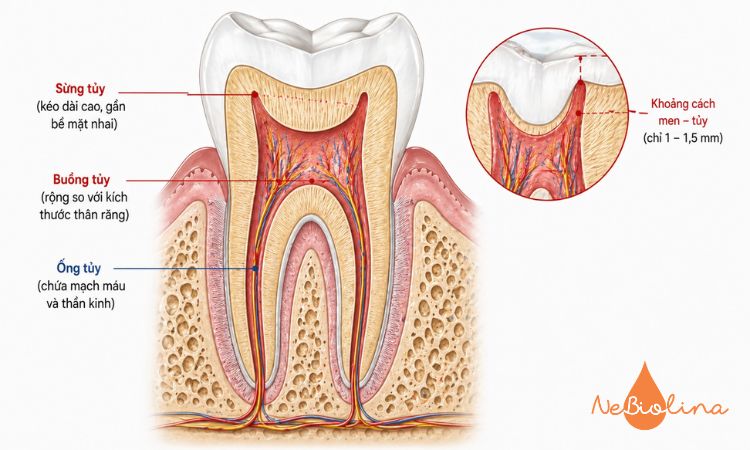Buồng tủy rộng, sừng tủy cao và sát bề mặt khiến răng sữa rất dễ lộ tủy khi bị tổn thương.