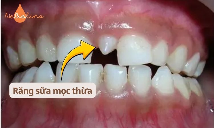 Răng sữa mọc thừa nằm giữa 2 răng cửa hàm trên.