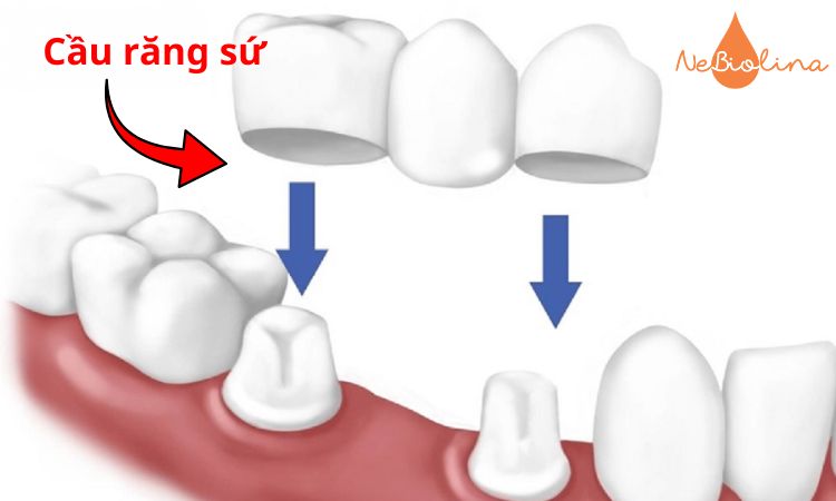 Cầu răng sứ được chỉ định khi không thể trồng Implant.