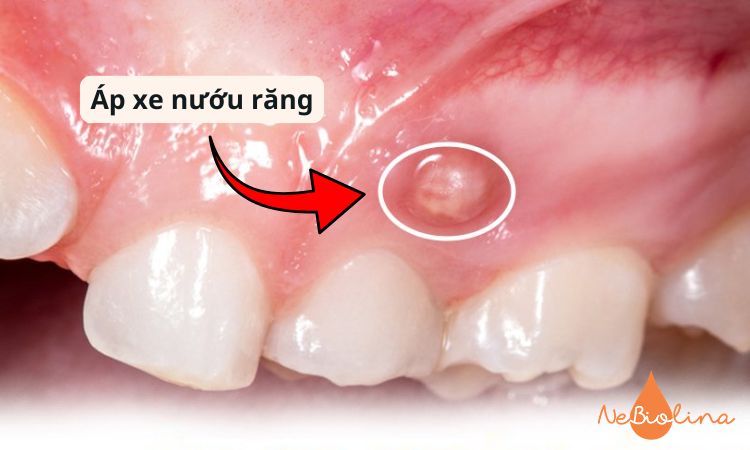 Sâu răng nặng không điều trị kịp thời gây áp xe nướu.