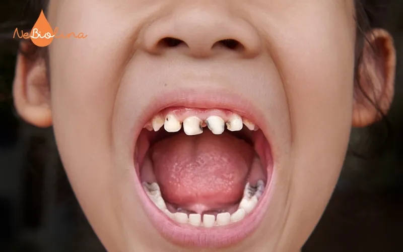 Trẻ bị sâu răng