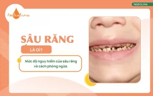 Sâu răng là gì
