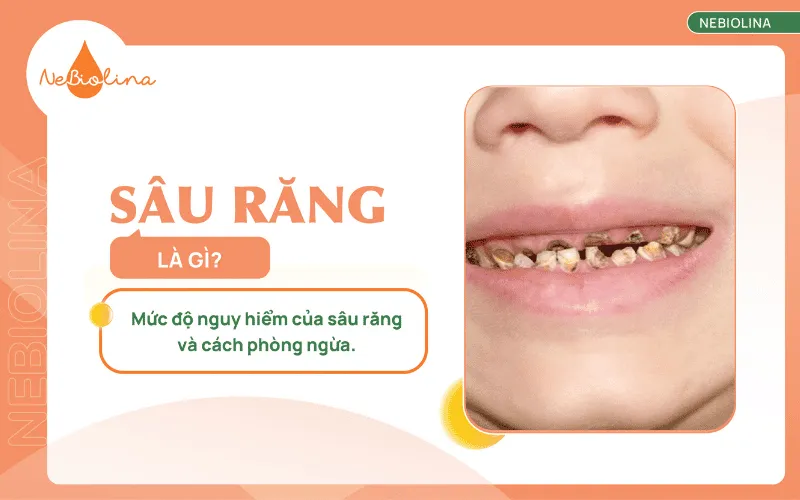 Sâu răng là gì
