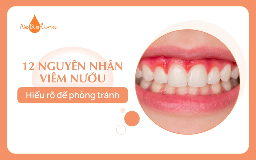 12 nguyên nhân viêm nướu