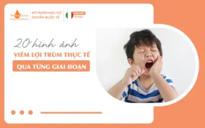 20 hình ảnh viêm lợi trùm thực tế qua từng giai đoạn