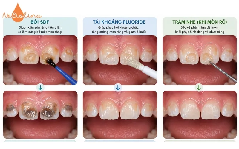 Tái khoảng flouride, bôi sdf ngăn chặn sún răng tiến triển