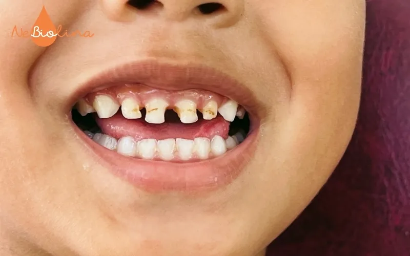 Răng sún lộ ngà cần đưa đi nha sĩ ngay
