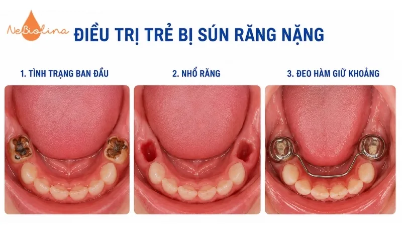 Răng sún nặng phải nhổ bỏ