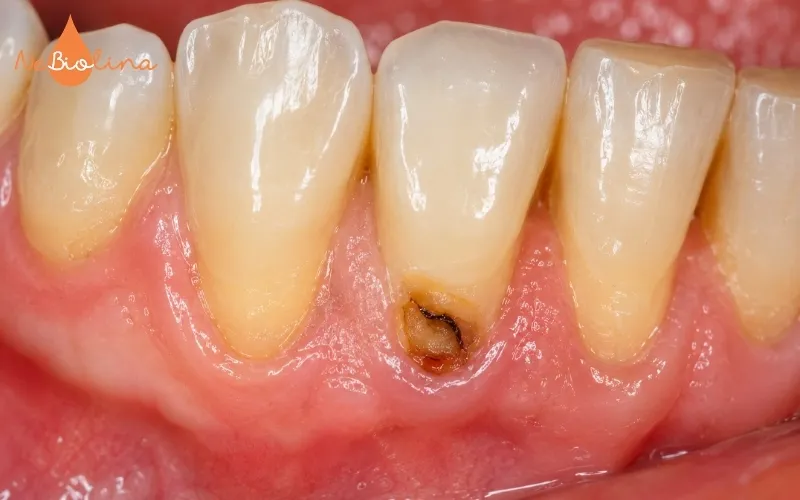 Người cao tuổi dễ bị sâu chân răng do tụt lợi