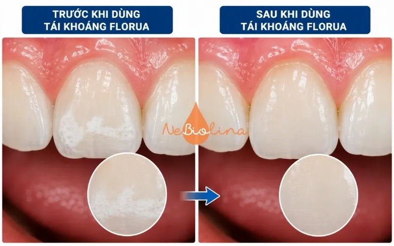 Tái khoáng florua giúp phục hồi răng sâu ở giai đoạn sớm