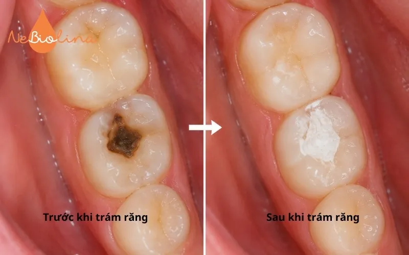Trám răng giúp ngăn ngừa sâu răng tiến triển
