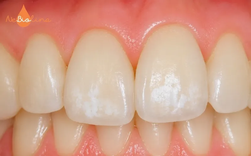 Đốm trắng ở răng-dấu hiệu sâu răng sớm