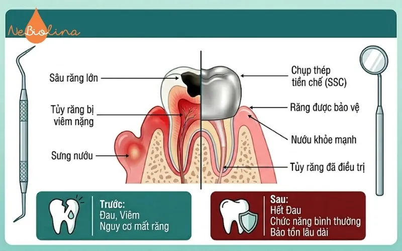 Điều trị tủy và bọc thep giúp bảo vệ răng