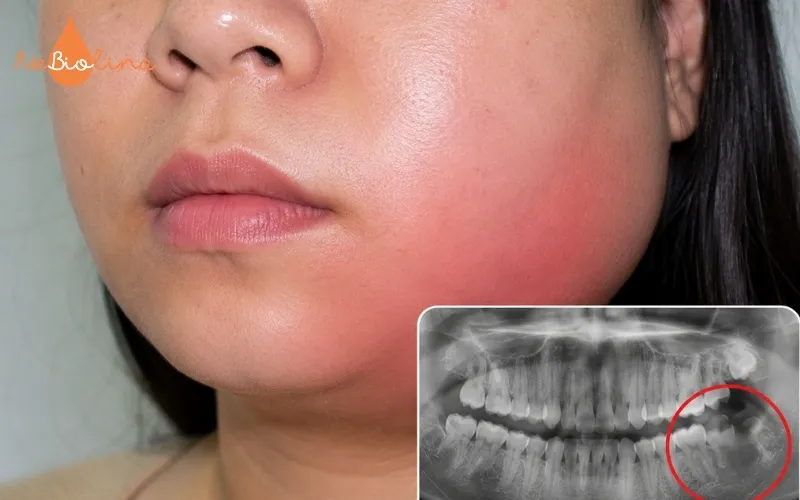 Hình ảnh viêm xương hàm do sâu răng
