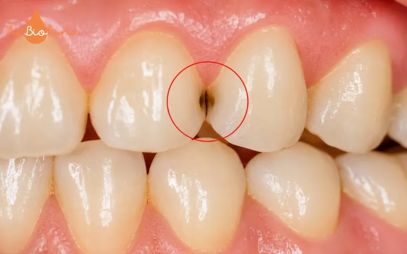 Sâu kẽ răng thường khó phát hiện