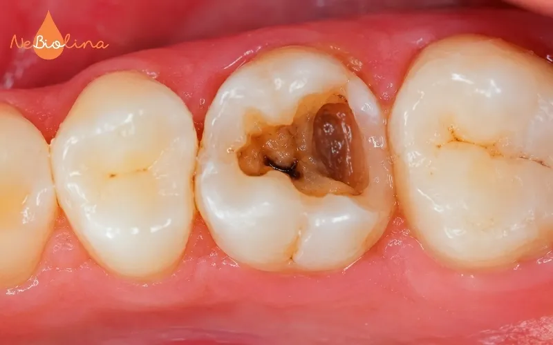 Răng hàm là vị trí dễ bị sâu răng nhất