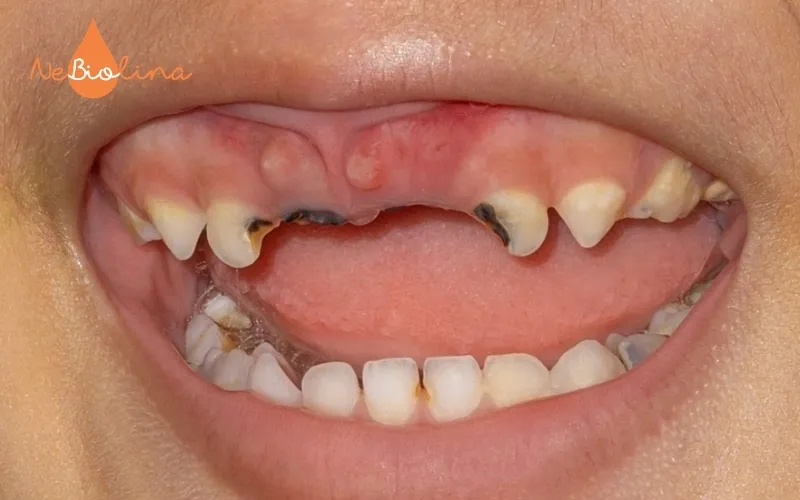 Trẻ nhỏ dễ bị sâu răng cửa