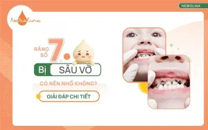 Răng số 7 bị sâu vỡ có nên nhổ không