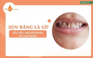 Sún răng là gì