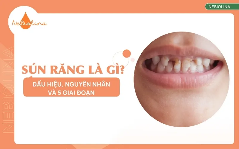 Sún răng là gì