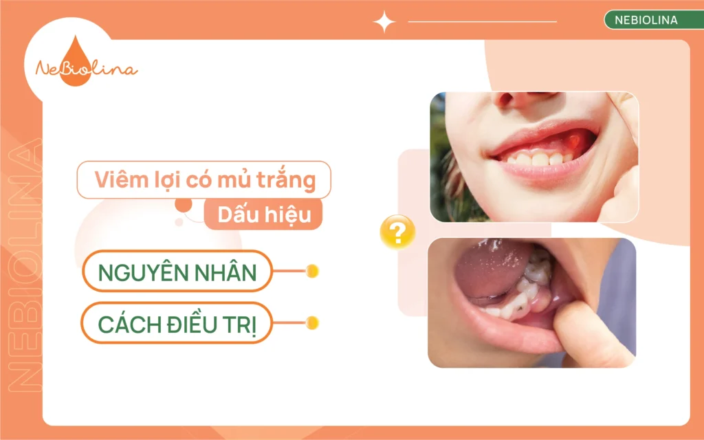Viêm lợi có mủ trắng
