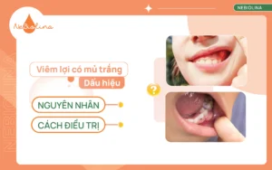 Viêm lợi có mủ trắng