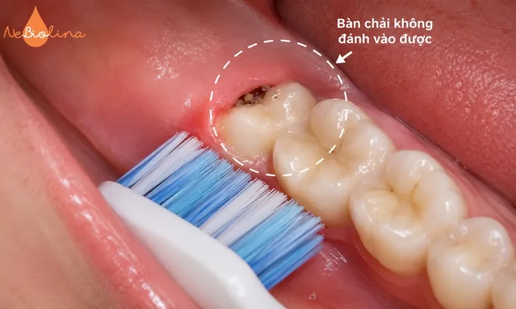 Khe hở là nơi tích tụ mảnh vụn thức ăn.