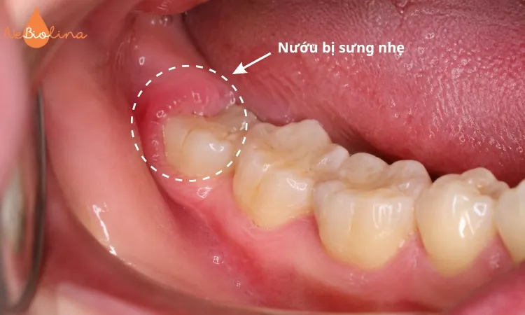 Nướu bị sưng nhẹ trong quá trình mọc răng khôn.