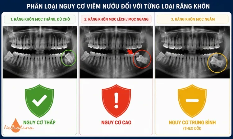 Viêm nướu răng cùng có thể xảy ra tuỳ vào từng loại răng khôn.