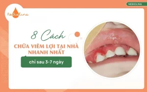 Cách chữa viêm lợi tại nhà nhanh nhất