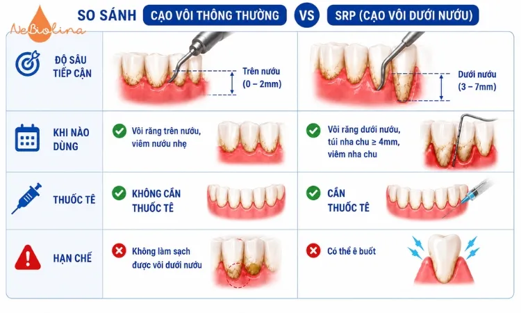 SRP làm sạch được các vùng mà cạo vôi thông thường không thể tiếp cận.