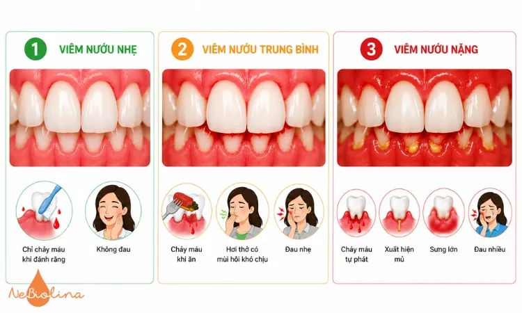 Viêm nướu răng được chia thành 3 mức độ.