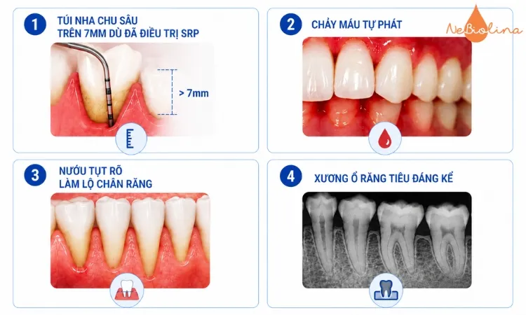 Bác sĩ yêu cầu phẫu thuật khi bị viêm nướu nặng.