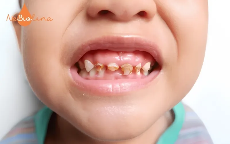 Sún răng lộ ngà răng
