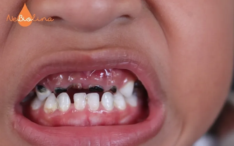 Sún răng gây mủn, đen răng