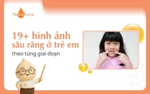 Hình ảnh sâu răng
