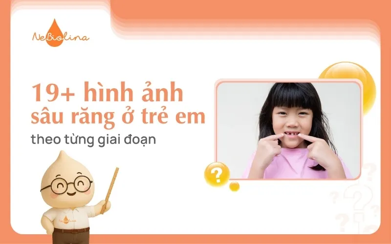 Hình ảnh sâu răng