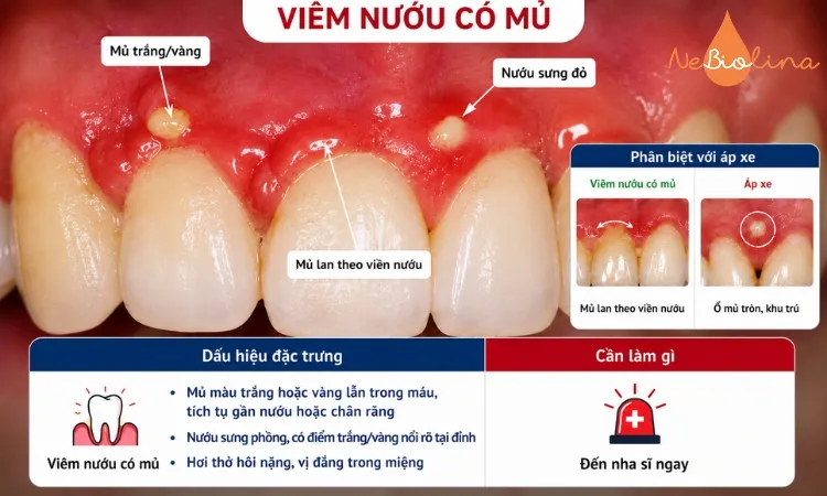 Hình ảnh viêm nướu có mủ.
