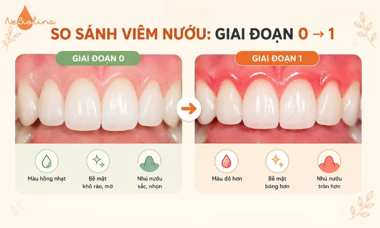 So sánh hình ảnh viêm nướu giai đoạn 0 và giai đoạn 1