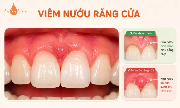 Viêm nướu răng cửa dễ phát hiện nhất trong các vị trí