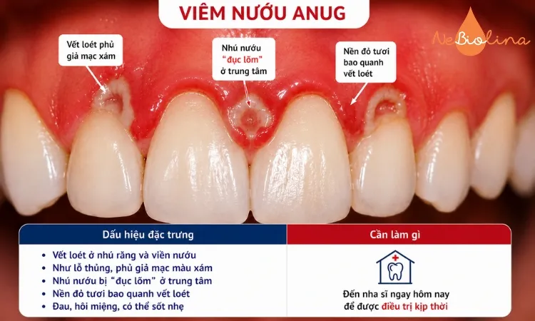 ANUG hình ảnh thực tế: nướu loét, sưng đỏ và có giả mạc đặc trưng.