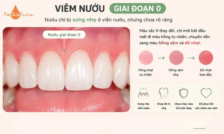 Nướu chuyển sang hồng sậm hoặc đỏ nhạt ở một vài vị trí ở viêm nướu giai đoạn 0