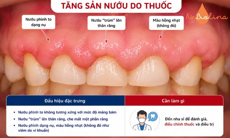 Hình ảnh tăng sản nướu do thuốc.