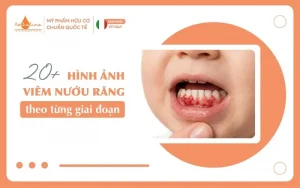Hình ảnh viêm nướu răng